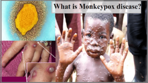 Monkeypox